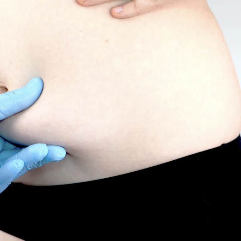 Liposuction Results Near Alexandria Virginia